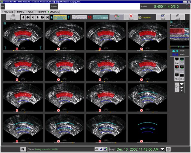 high intensity focussed ultrasound